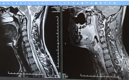 MS hastalığında erken teşhis hayat kalitesini arttırıyor